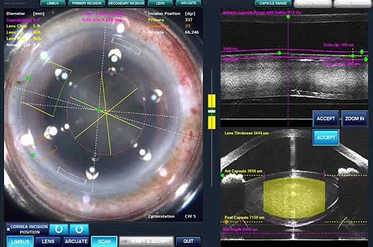 FEMTO LASER CATARACT SURGERY, DR D D VERMA,DIRECTOR, D D EYE INSTITUTE, KOTA, RAJASTHAN, INDIA.