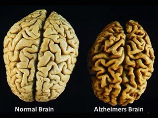Cannabis and Alzheimer's Disease - Short Documentary
