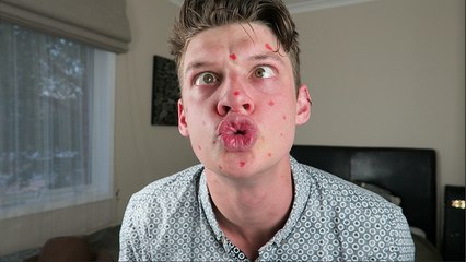 How To Cover Up Your Pimple