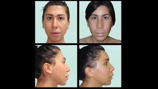 Transgender surgery - Female to male surgery & Male to female surgery