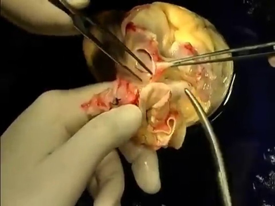 Heart Transplant Surgery Live Video