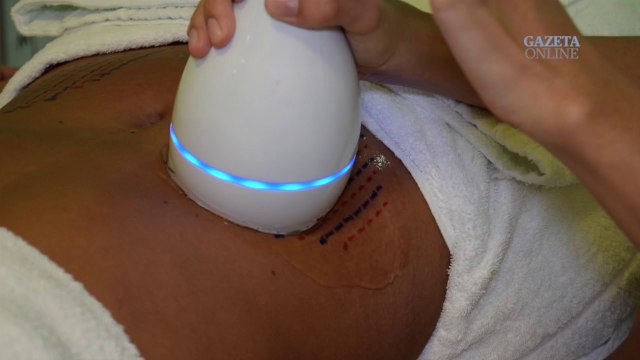 No Camarim #6 - Saiba como funciona o Lipo Soon e fique enxuto para o verão