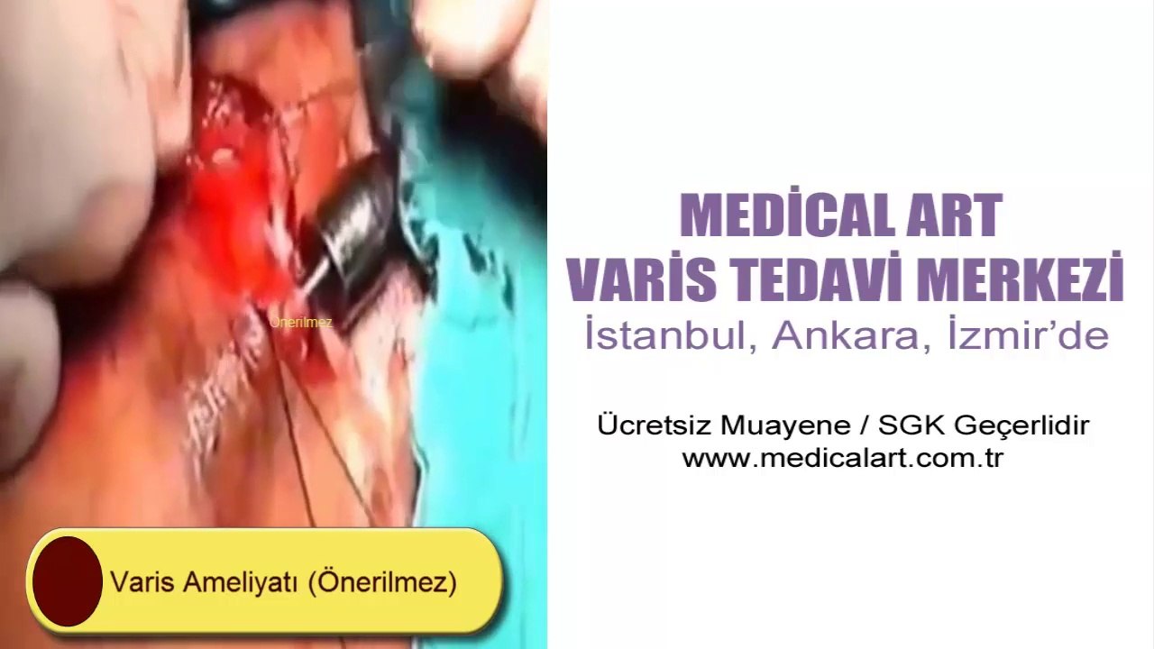 Varis Ameliyatı Nasıl Yapılır?