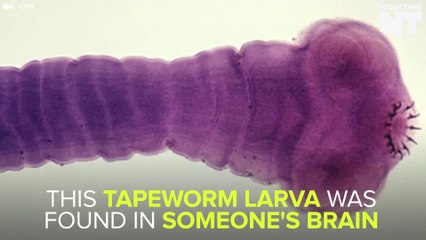 Doctors Discover Live Tapeworm In College Student's Brain