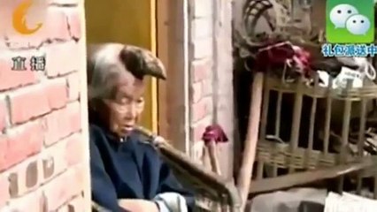 Lei è la donna unicorno, ma la sua è una malattia rarissima