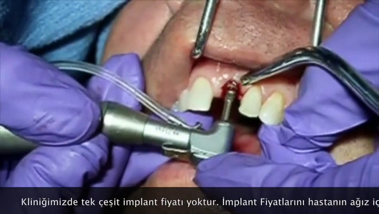Batıkent - implant diş uygulaması www-vegadent-net-batikent-implant-dis