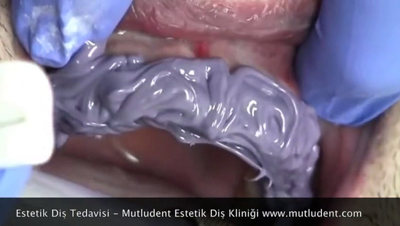 Estetik Diş Tedavisi Ankara Diş Hekimi  www.mutludent.com/ankara-dis-hekimi.html