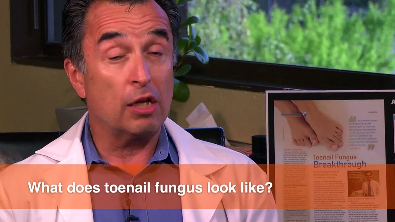 What does Toenail Fungus look like?