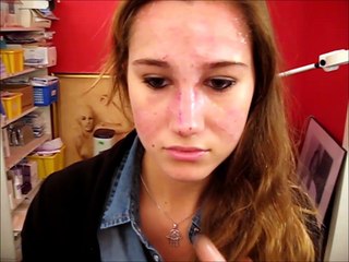 rhinoplastie avant-après déplâtrage, par vladimir mitz