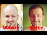 Finding The World's Best Hair Transplant Surgeons