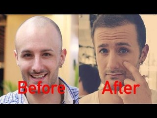 Importance of your FIRST Hair Transplant Surgery - FAQ