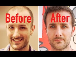 How many hair transplant procedures will you need? - FAQ