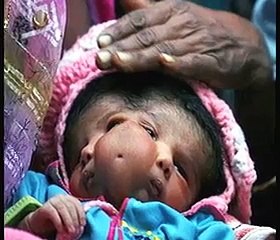 A boy born in India with 2 Heads Shocked the World