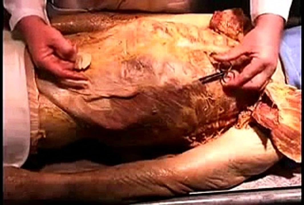 New video human autopsy