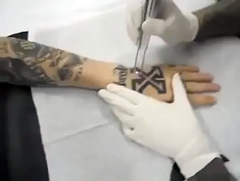 Amazing Tattoo Removal