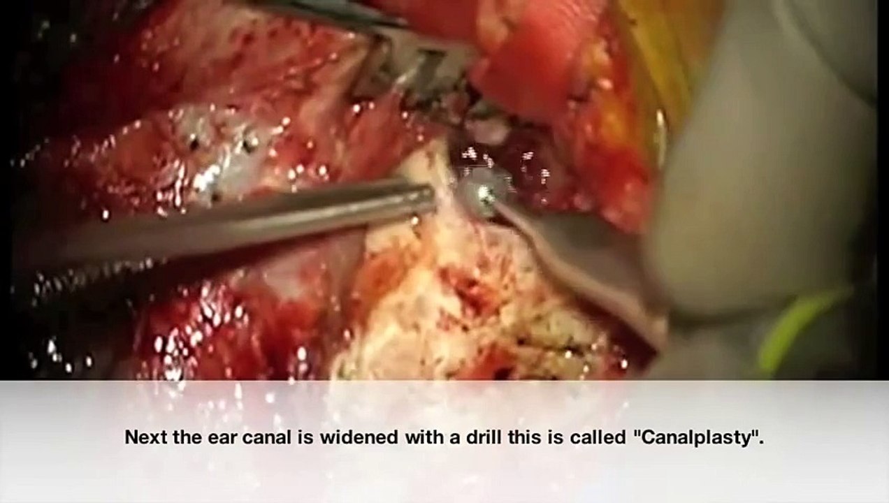 [ medical social ] A Fungal Ear Infection Causing Ear Drum Hole Video