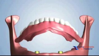 Fixed Bridges Dentures Implants [ medical social ]