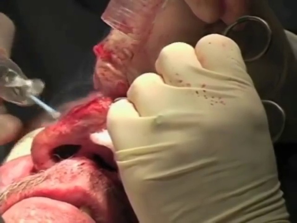 Dermatology Rhinophyma