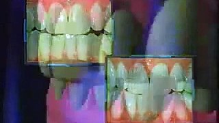How make Teeth Whitening