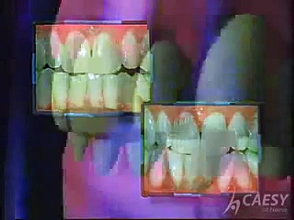 How make Teeth Whitening