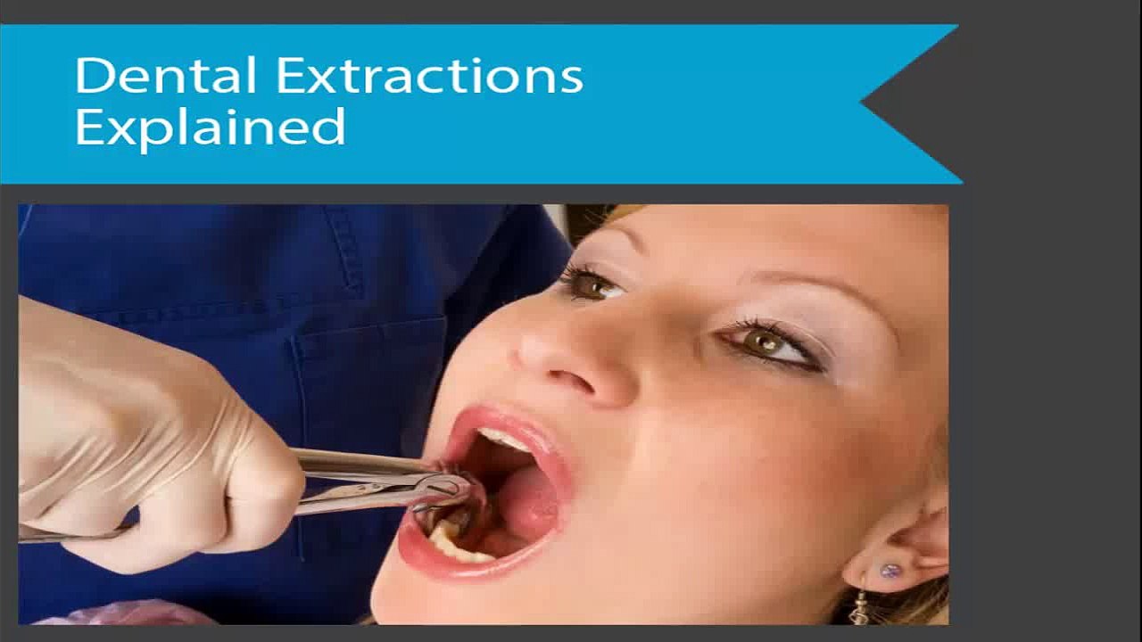 Dental Extractions Explained VT