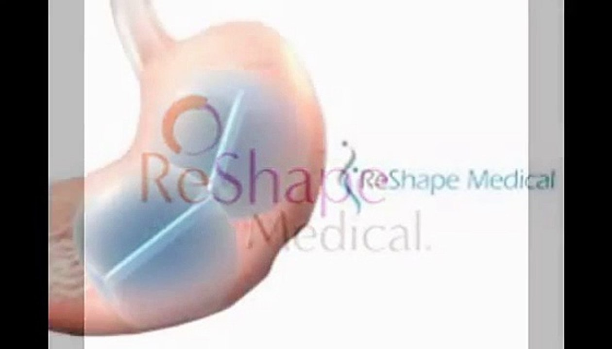 stomach gastric balloon weight loss