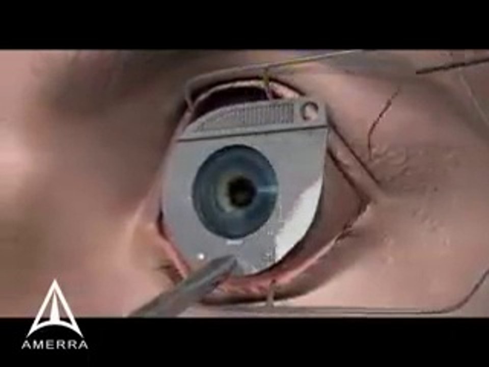 How is the eye oparation