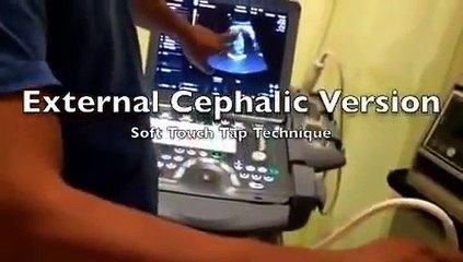 How to turn a breech baby at 37 weeks in 100 seconds