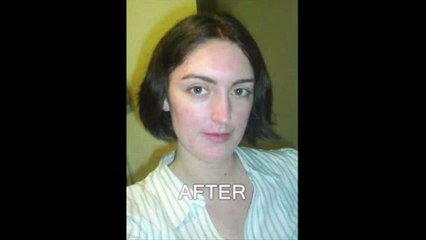 Acne Treatment - Solution