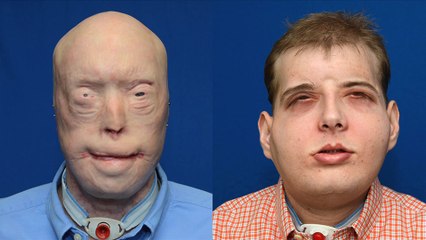 Une greffe totale du visage réalisée aux Etats-Unis