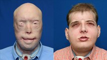 US team carries out most complex face transplant