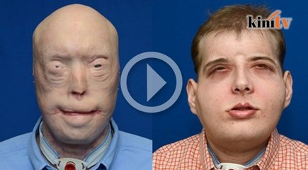 Manusia pertama jalani pemindahan muka penuh