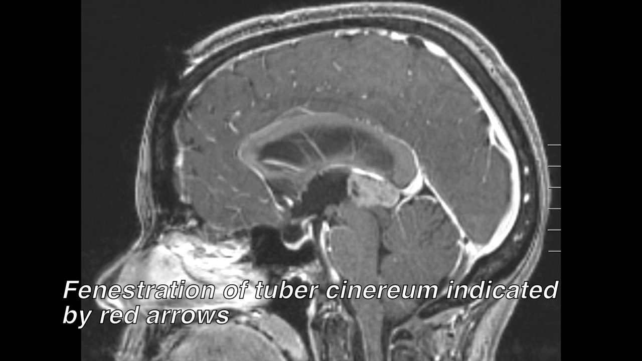 Hydrocephalus & Surgery