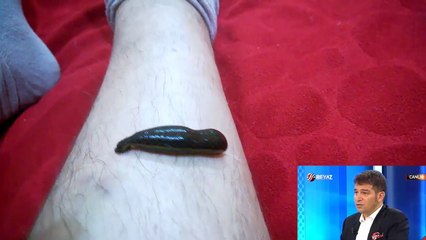 Sülükle Varis Tedavisi İşe Yarar mı?