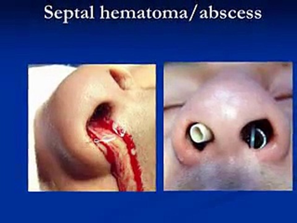 ENT Emergencies (Nose) by Dr Meena Nihalani ( ENT Specialist in Indirapuram)