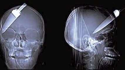 Most bizarre things found on x_rays