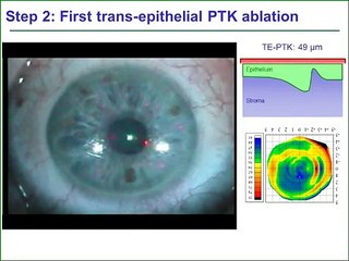 Refractive surgery & Photorefractive keratectomy
