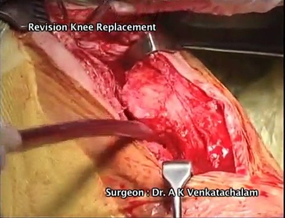 knee replacement surgery new horizons
