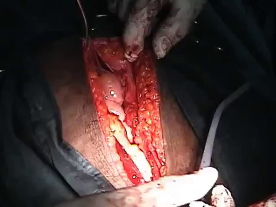 Total Abdominal Hysterectomy procedure