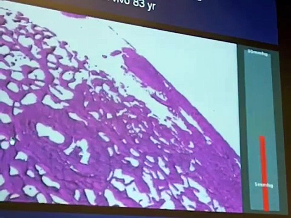 Popular Glaucoma & Optic nerve videos