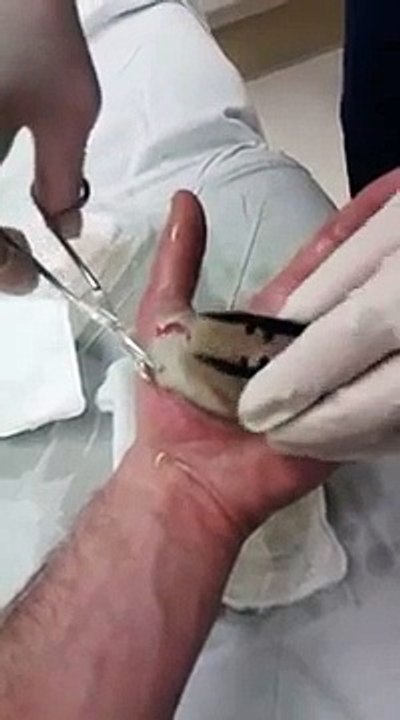 huge burn blister treatment