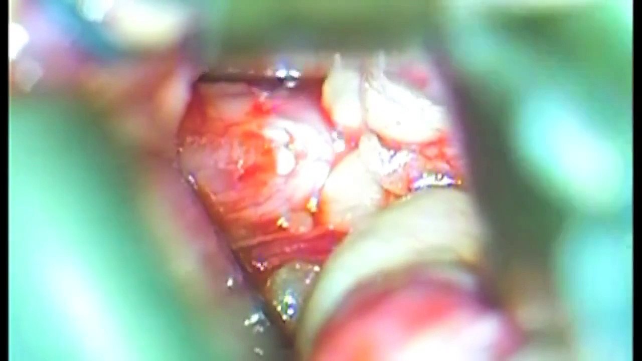 DR.AGARWALS EYE HOSPITAL - WINDOW TO THE WORLD-OPTIC NERVE SHEATH FENESTRATION.mpg