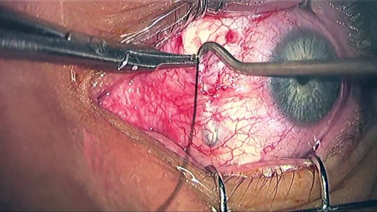Optic nerve & Surgery