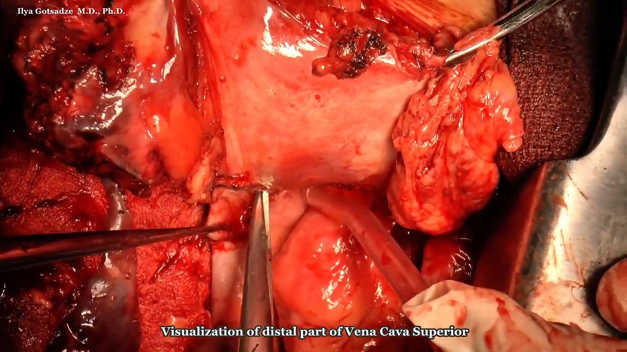 Popular Mediastinal tumor & Mediastinum videos