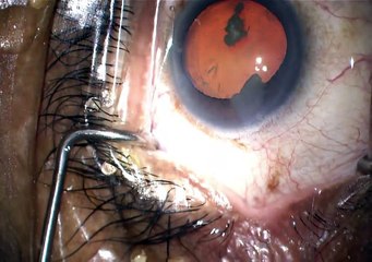 case 1 trabectome phaco superficial keratectomy part 3