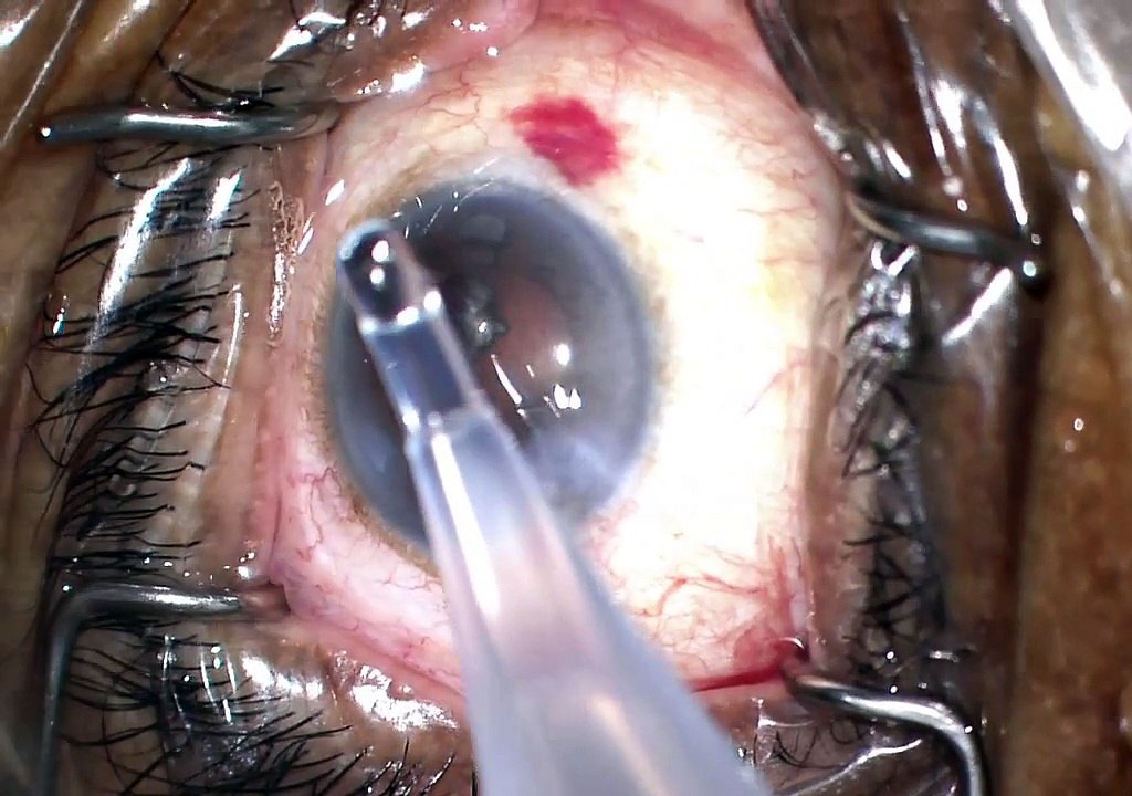 case 1 trabectome phaco superficial keratectomy part 1 narrow angles