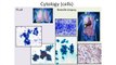 Fighting Lung Cancer, Part 3 | Advances in Early Lung Cancer Detection