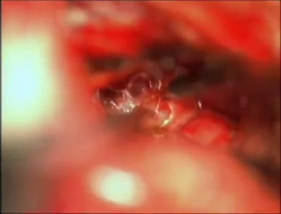 How to perform resection of pineal region tumors by occipital transtentorial approach