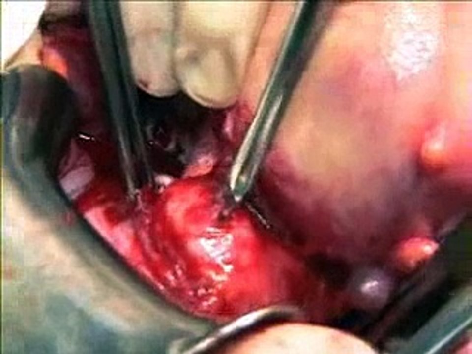 histerectomia vagina con mocelacion