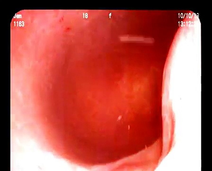 Cystoscopy Male Surgery - Patient Education HD